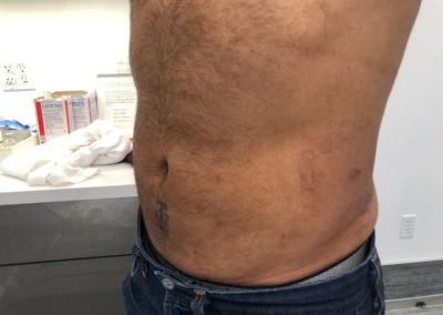 Male Liposuction AFTER